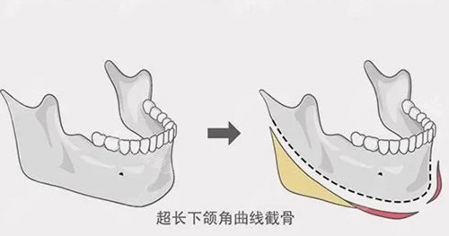 長(zhǎng)曲線(xiàn)下頜角手術(shù)示意圖