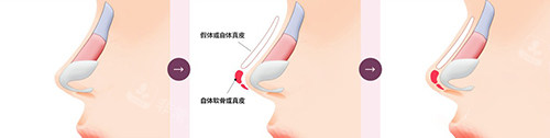 隆鼻手术过程