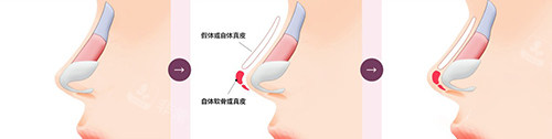 隆鼻手術(shù)過程