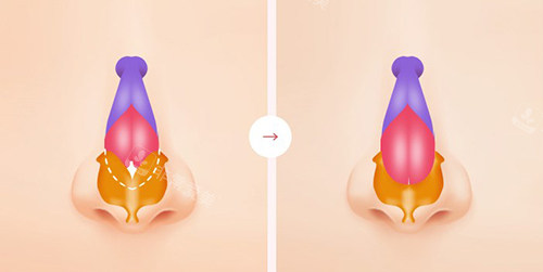 隆鼻整形手术前后