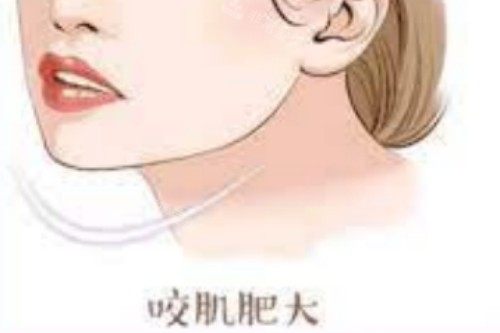 瘦臉針宣傳圖
