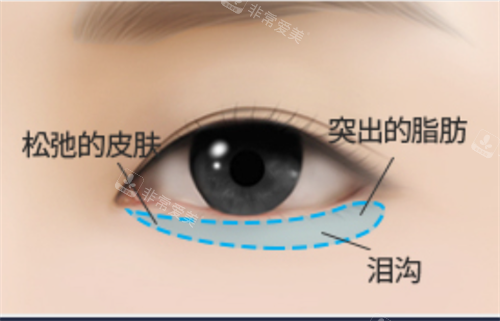 下眼睑老化怎么办？韩国欧佩拉下眼睑美容手术有哪些