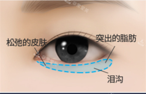 下眼瞼皮膚老化、脂肪堆積、淚溝示意圖