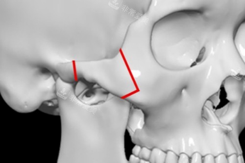 韩国H整形外科医院颧骨手术展示图