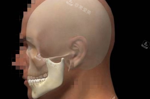 顴骨手術模擬圖
