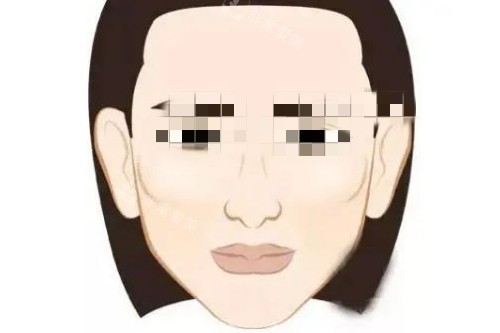 顴骨手術示意圖