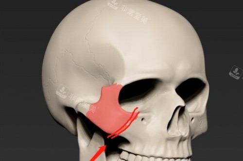 颧骨手术模型图