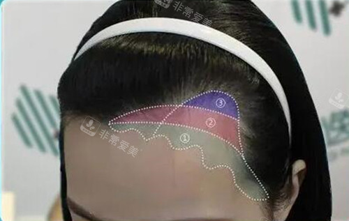 女士发际线植发设计图