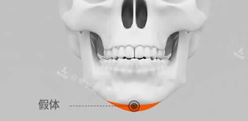 韩国秀美颜整形外科假体垫下巴手术介绍