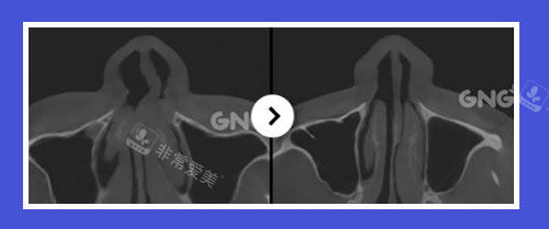 鼻中隔弯曲CT照片
