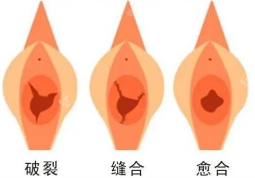 阴道缝合手术过程图