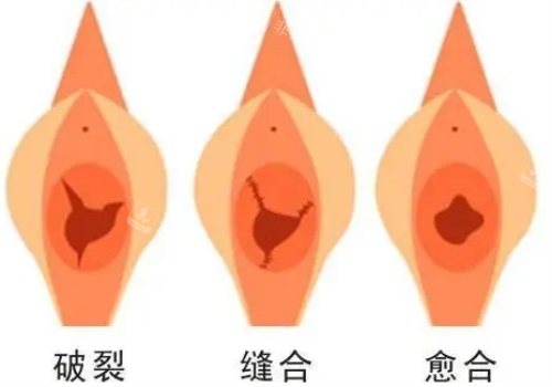 陰道縫合手術(shù)過程圖