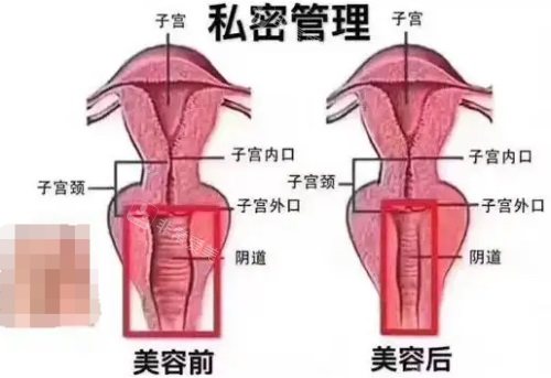 私處美容前后示意圖