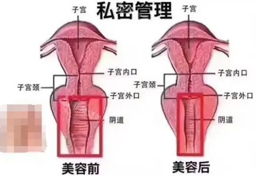 私处美容前后示意图