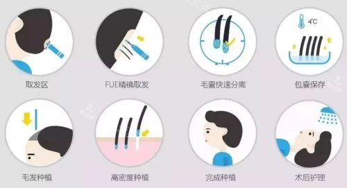 植發(fā)詳細(xì)過(guò)程示意圖 植發(fā)詳細(xì)過(guò)程示意圖