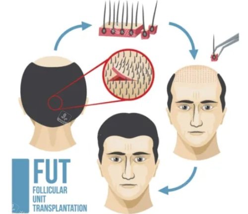 FUT植发技术图解
