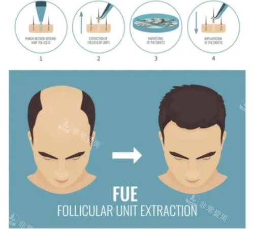 FUE植發(fā)技術(shù)示意圖 FUE植發(fā)技術(shù)示意圖