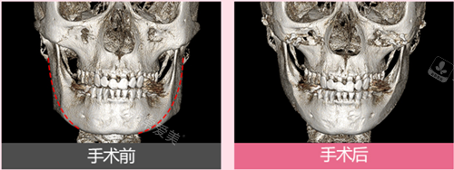 韩国丽延长整形外科下颌角手术骨骼图
