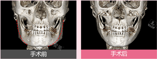 为啥推荐韩国丽延长下颌角手术?3DCT专有技术并不是每家都有