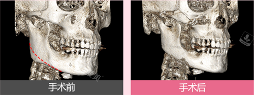 韩国丽延长整形外科下颌角手术侧面骨骼图
