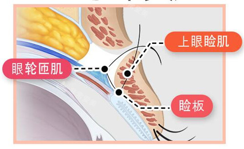 上眼瞼提肌、瞼板示意圖