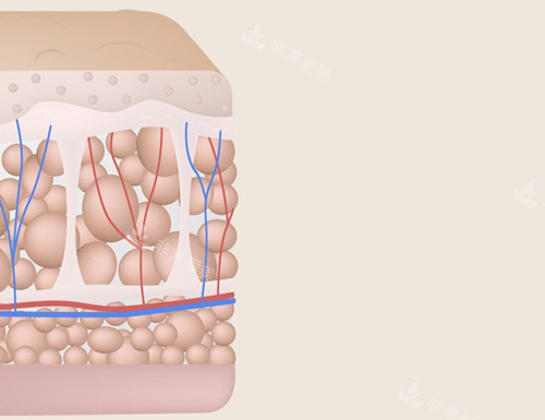 皮肤脂肪微整术后示意图