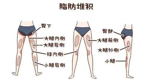 在韩国芙莱思整形医院做了大腿环吸后,筷子腿的感觉太爽啦