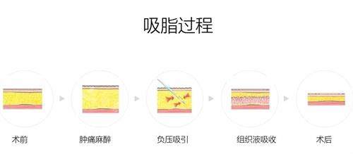 韓國芙萊思整形醫(yī)院吸脂步驟示意圖