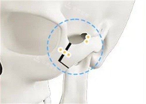 颧骨钛钉示意图