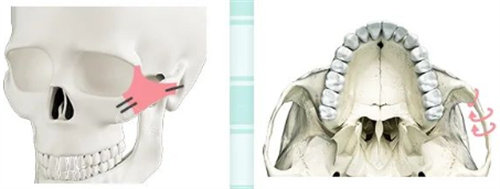 颧骨整形示意图