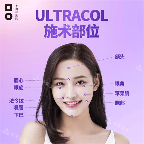 胶原蛋白提升注射ULTRACOL可注射部位