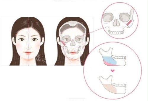 磨骨整形卡通图