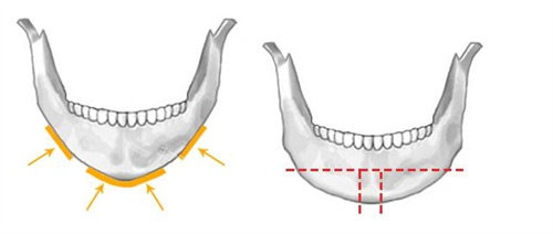下巴整形示意图