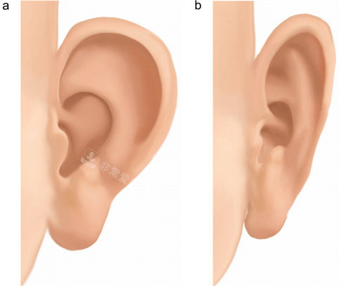 耳朵整形图片对比图片