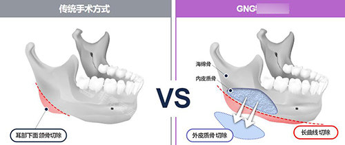 韩国GNG整形外科轮廓手术