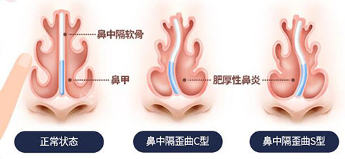 不同的鼻中隔弯曲类型图