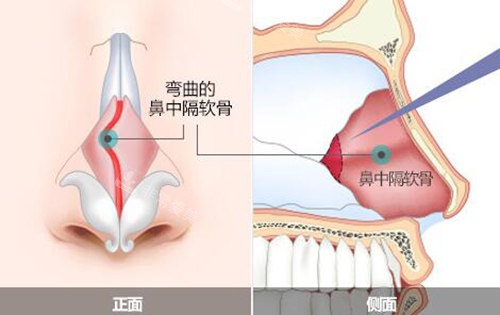 鼻中隔弯曲卡通图展示