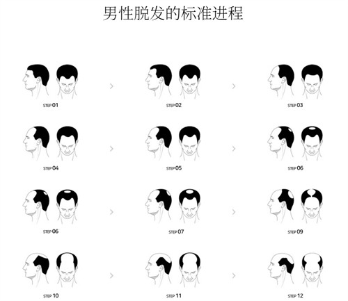 男性脫發(fā)的進程展示圖 男性脫發(fā)的進程展示圖