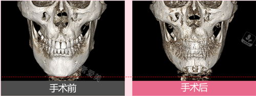 韩国丽延长下巴整形正面骨骼图