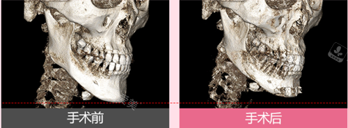韩国丽延长下巴整形侧面骨骼图