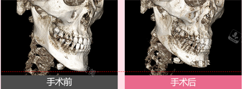 韓國麗延長下巴整形側(cè)面骨骼圖