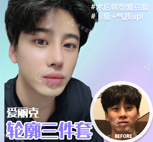 韓國(guó)愛(ài)麗克整形外科輪廓三件套真人病例圖