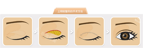 韓國貝緹萊茵整形醫(yī)院上眼瞼 韓國貝緹萊茵整形醫(yī)院上眼瞼