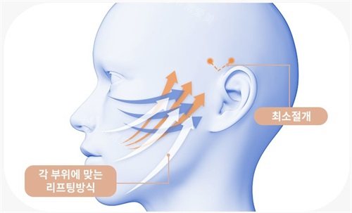 韩国绮林整形外科医院面部提升示意图