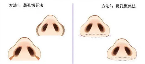 鼻翼手术方法图