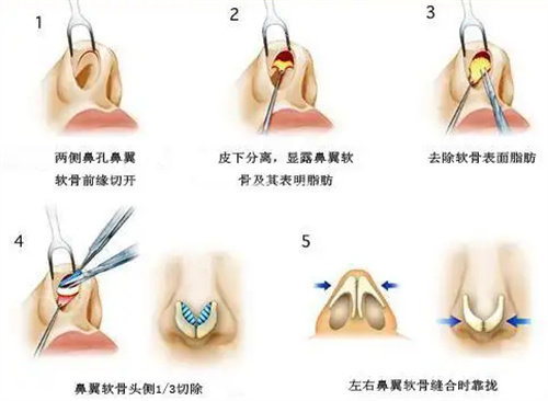 鼻翼整形手术步骤图