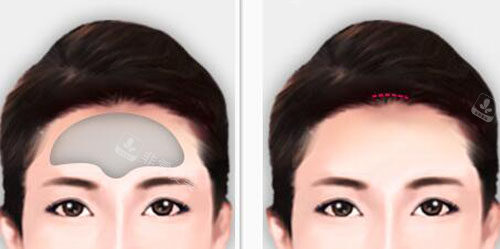 韩国秀美颜整形外科额头整形示意图