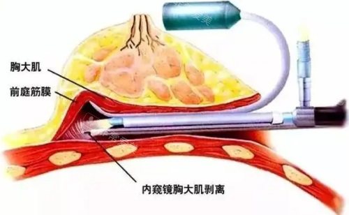 內(nèi)窺鏡隆胸示意圖