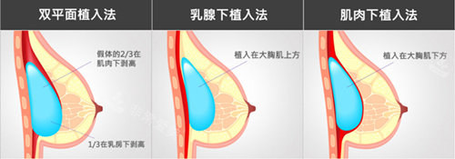 三种假体隆胸植入术式