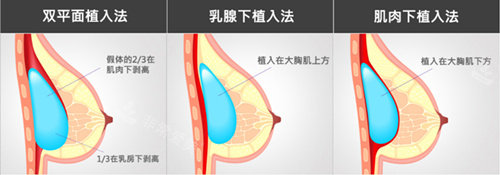 三種假體隆胸植入術(shù)式